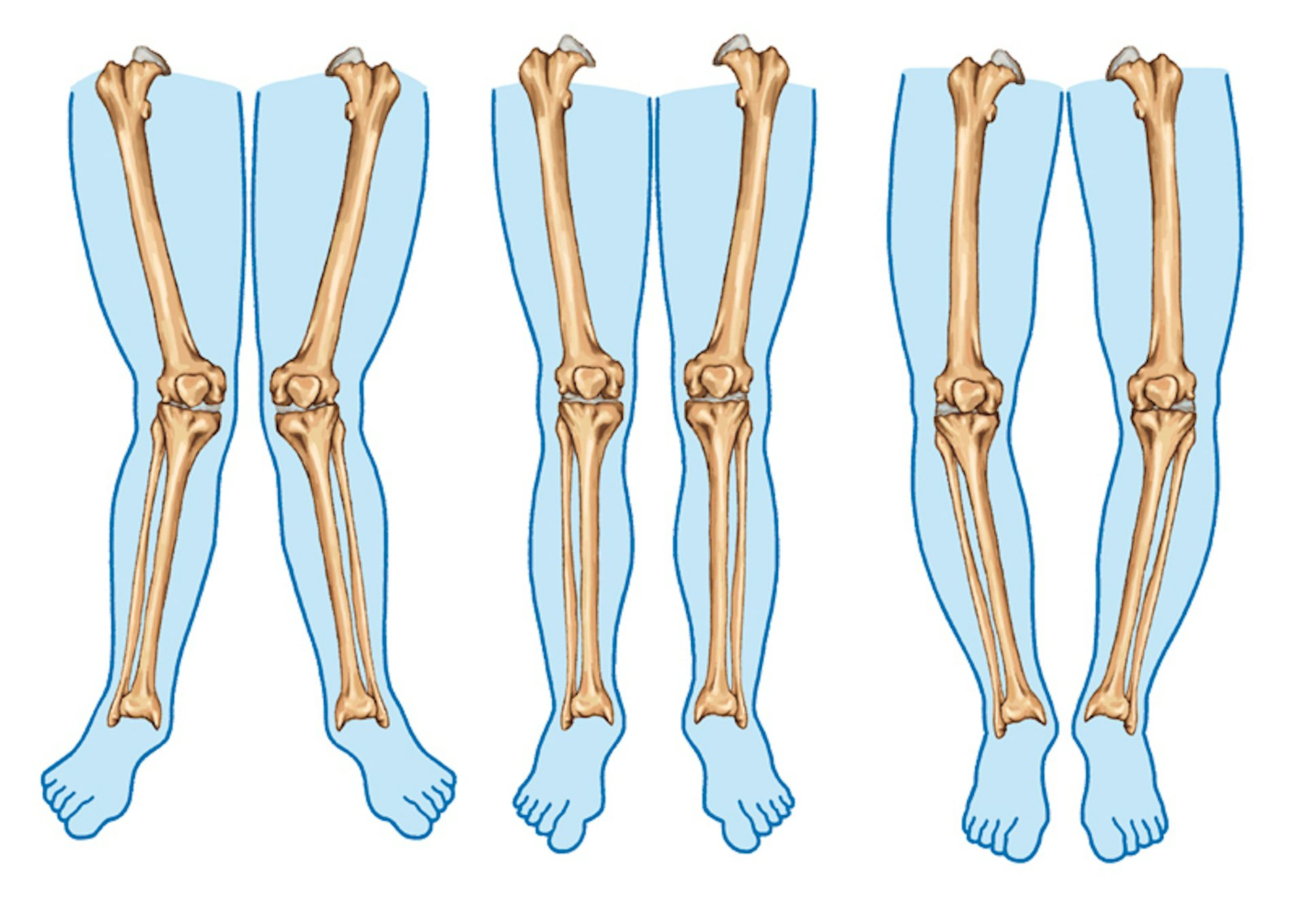 Explainer: What Causes Knock Knees And Do They Have To Be Treated?