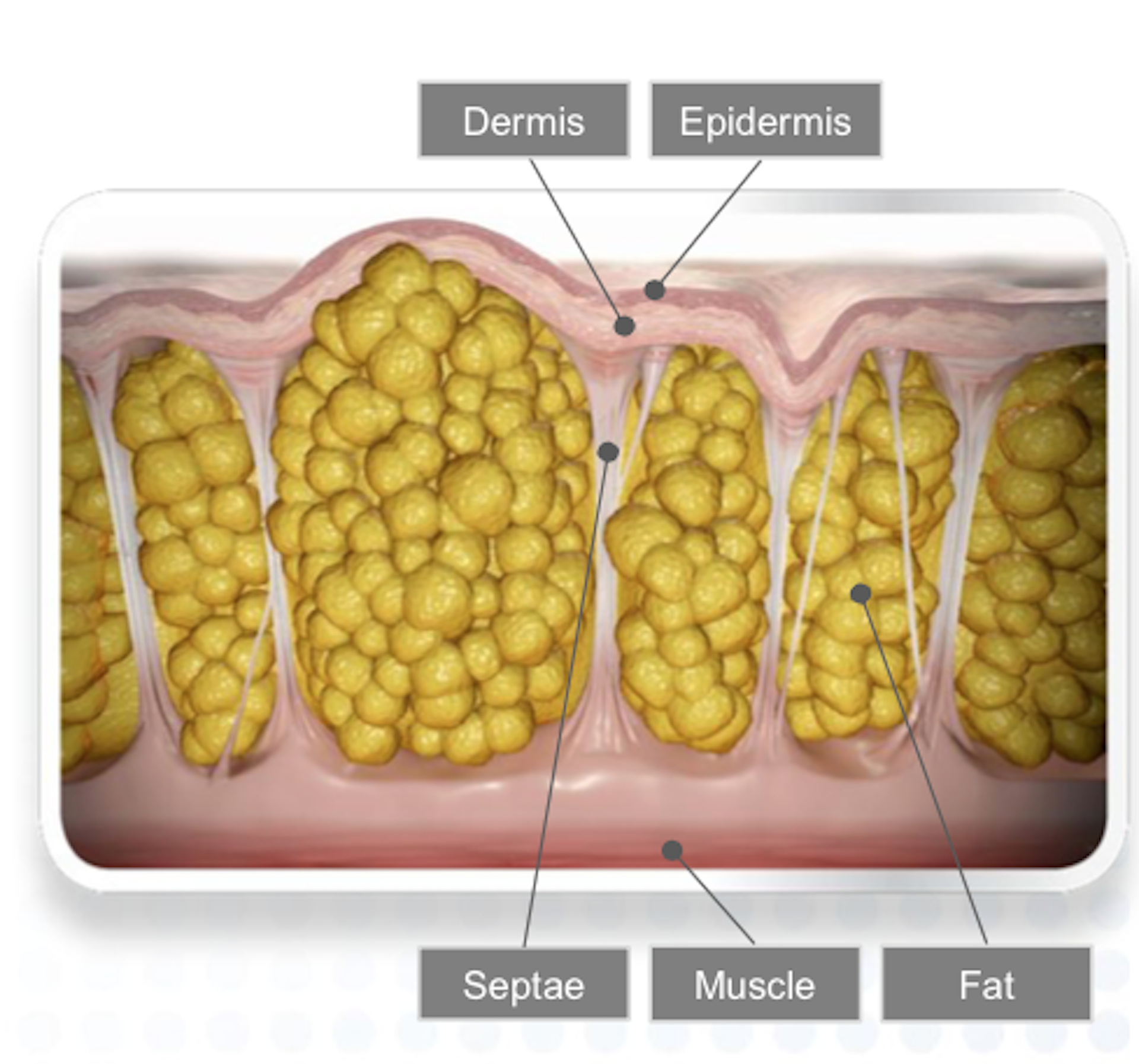 Health Check what is cellulite?